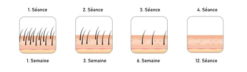 Ã‰pilateur IPL pour Hommes - Namido