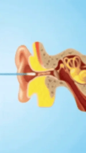 iClean - Voyez ce qu'il y a dans vos oreilles !