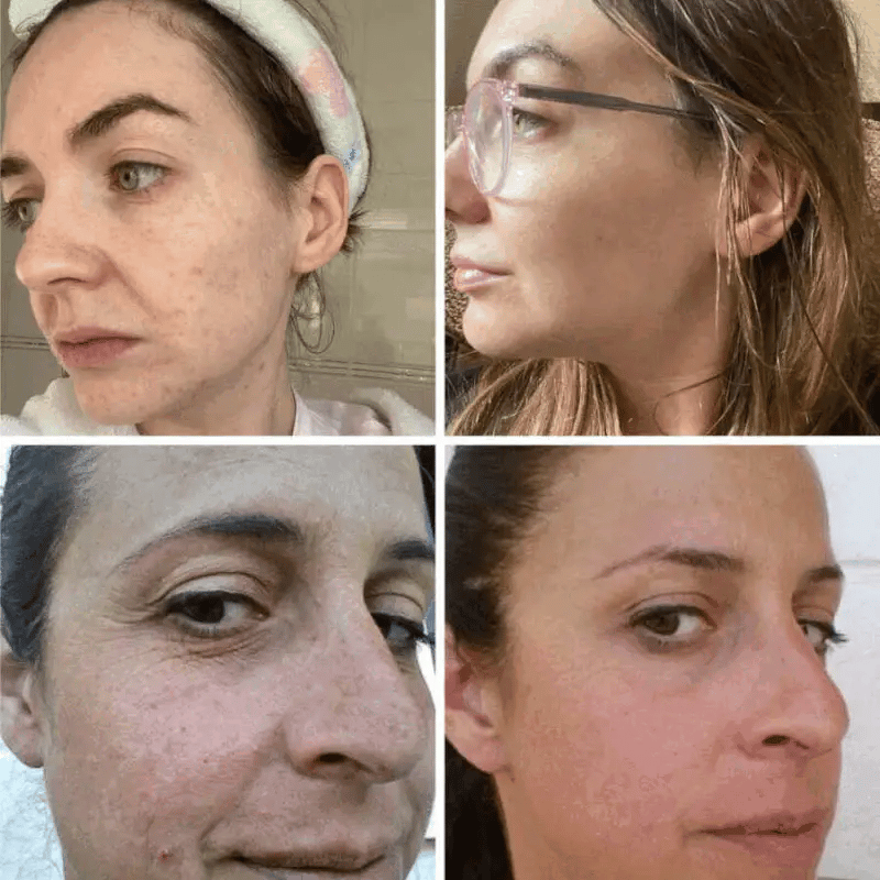 Masque LED Pour Visage | Koliza