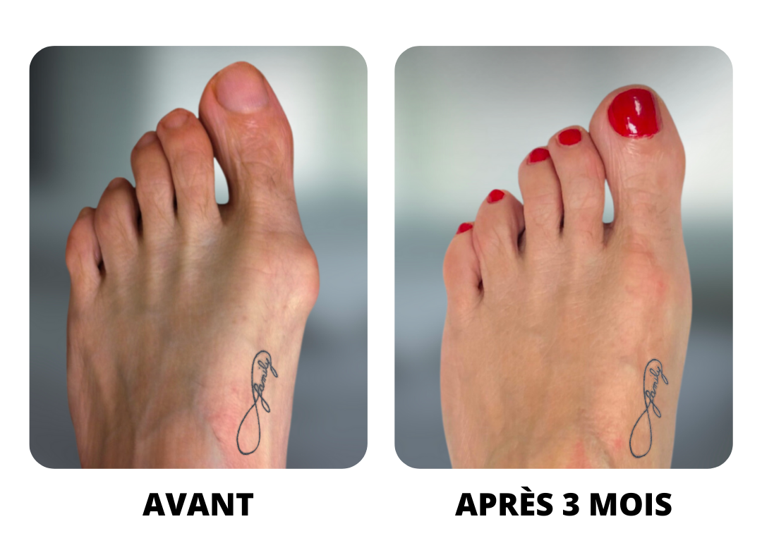 Correcteurs pour l'hallux valgus
