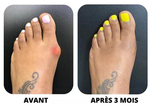 Correcteur universel pour hallux valgus